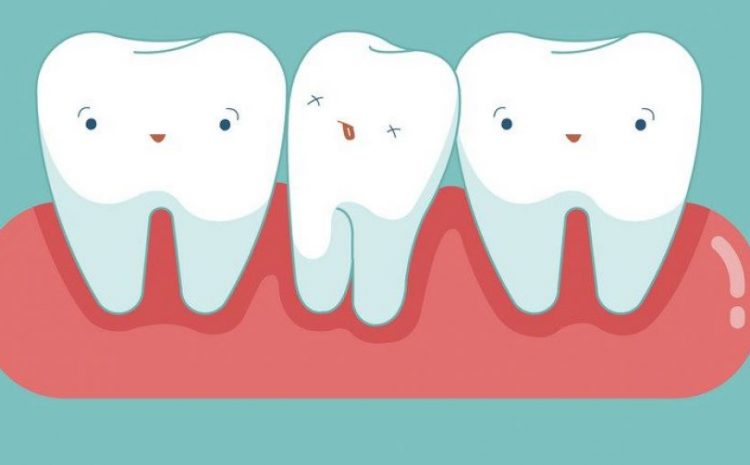  Dente del giudizio – Domande e risposte dell’esperto